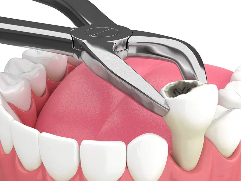 digital mockup of tooth extraction