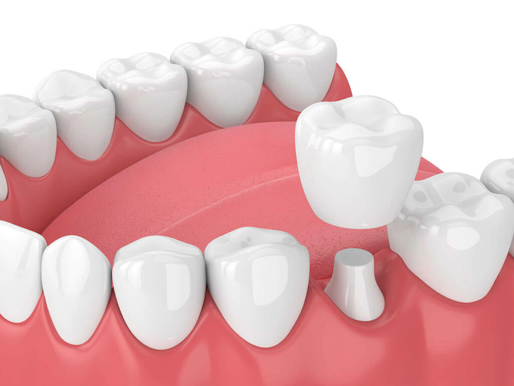 visual mockup of bottom row of teeth and a tooth receiving dental crown