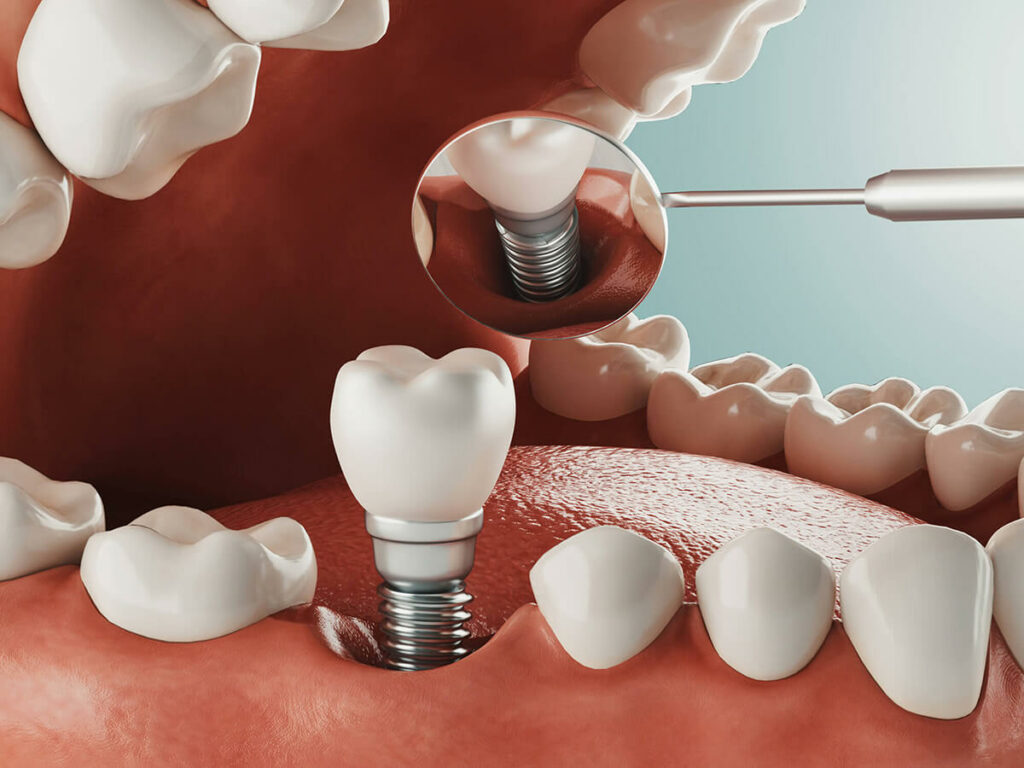 visual mockup of a bottom row of teeth getting a dental implant