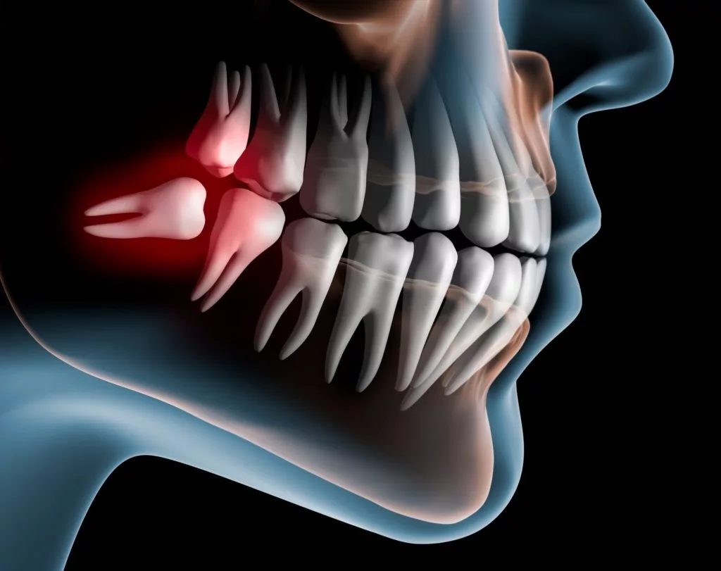 visual mockup of an impacted wisdom tooth