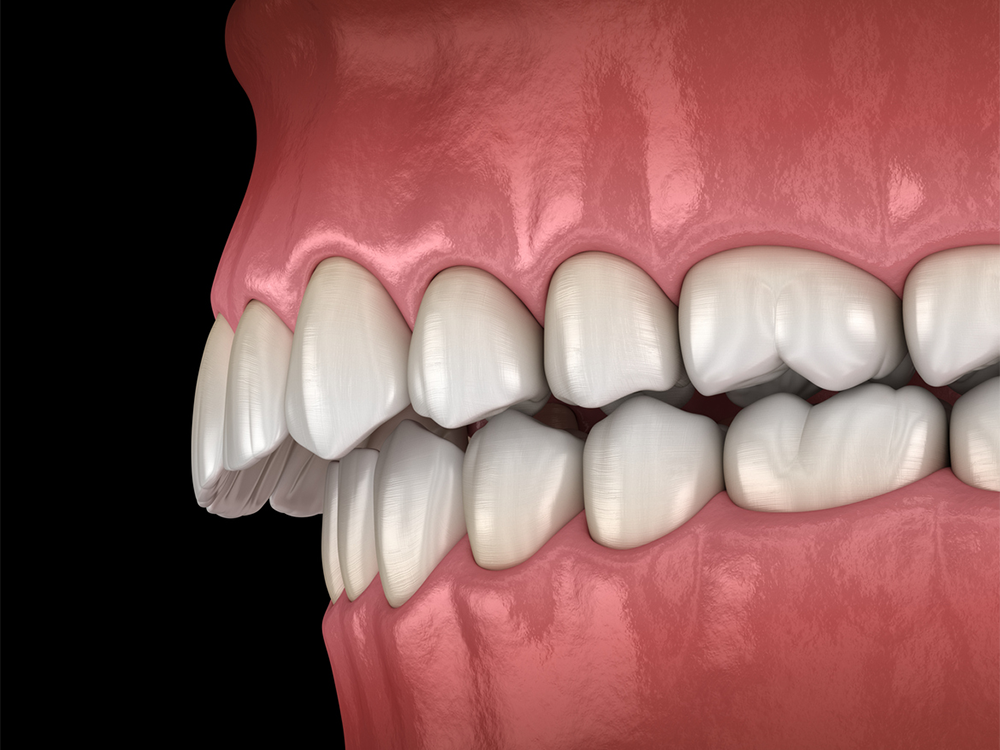 visual mockup of a mouth showing an overbite