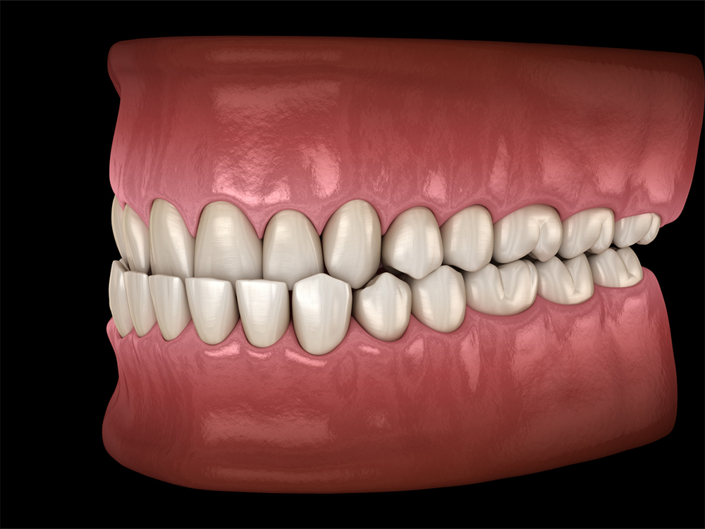 visual mockup of a mouth showing an under bite